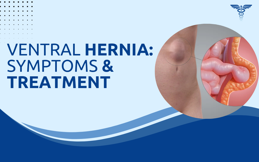 Ventral Hernia Symptoms & Treatment