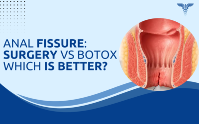 Anal Fissure: Surgery vs Botox Which Is Better?