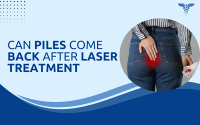 Can Piles Come Back After Laser Treatment?