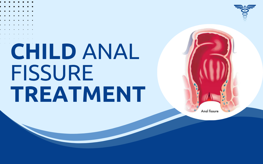 Child Anal Fissure Treatment