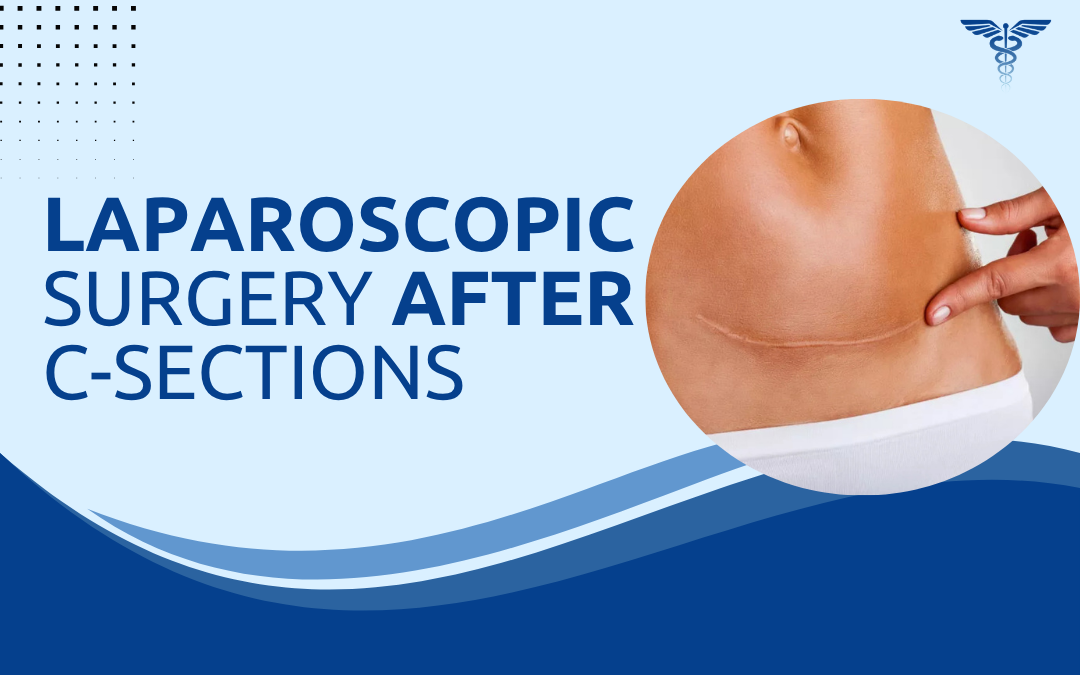 Laparoscopic Surgery After C-Sections