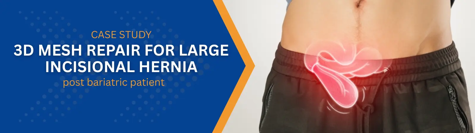 Case study banner for 3D mesh repair of recurrent hernia, with blue left panel and a patient in a hospital showing abdominal pain on the right (red highlighted area).