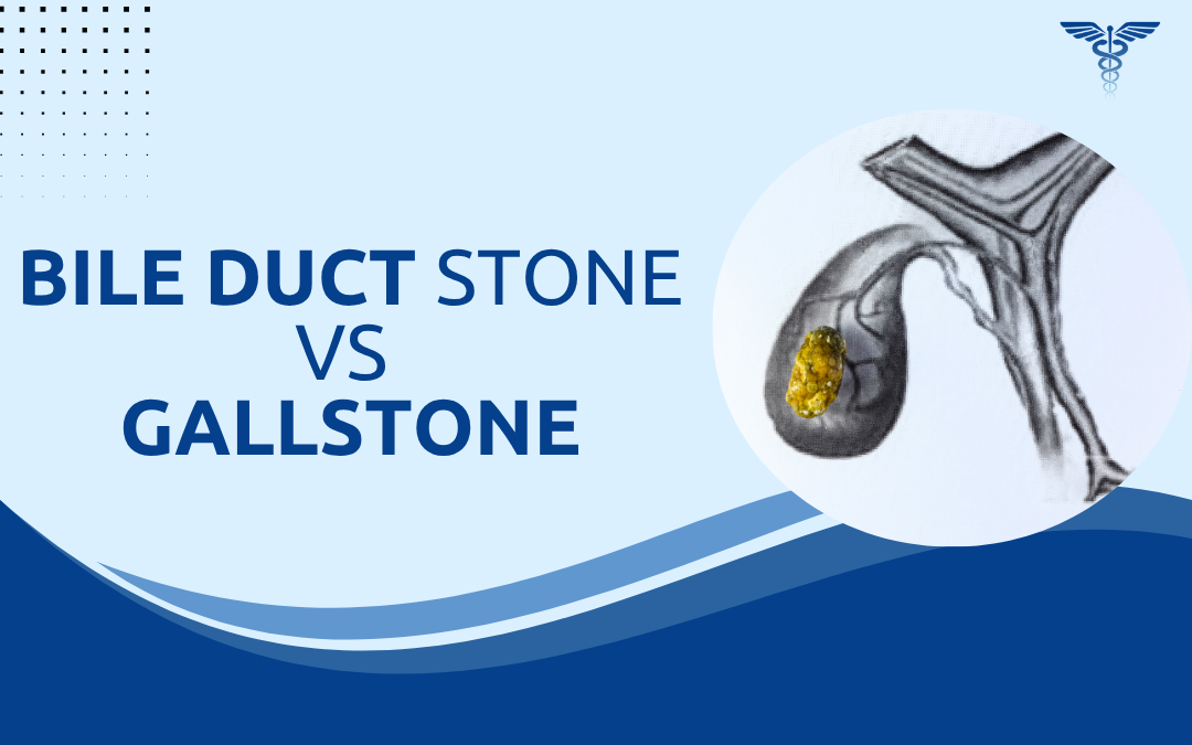 Bile Duct Stone vs Gallstone