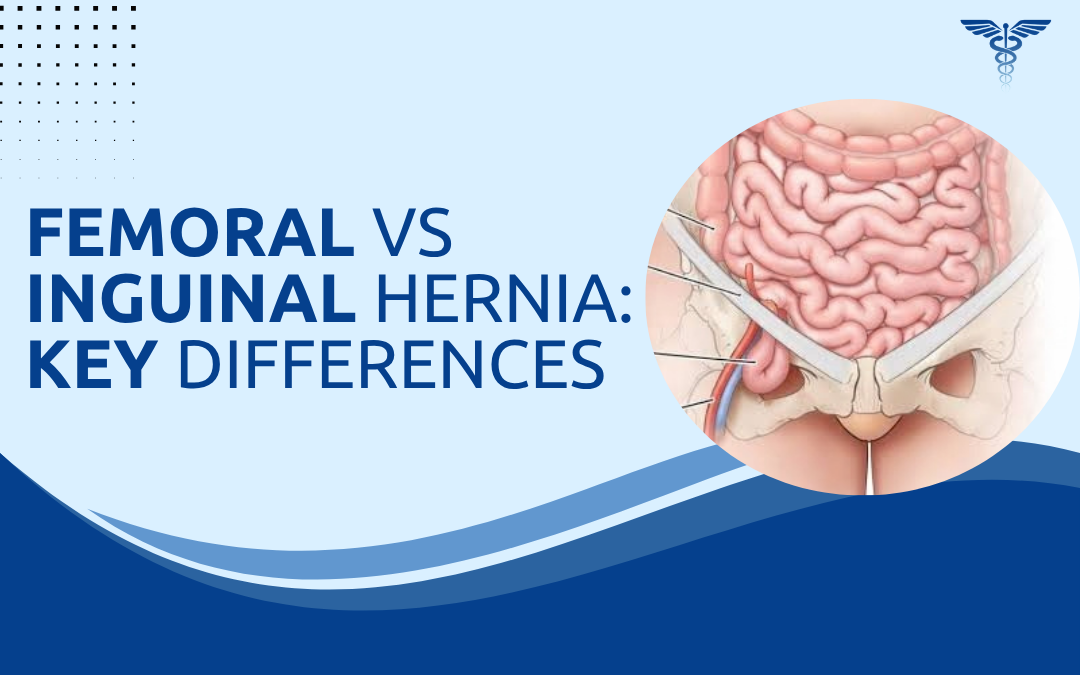 Femoral vs Inguinal Hernia Key Differences