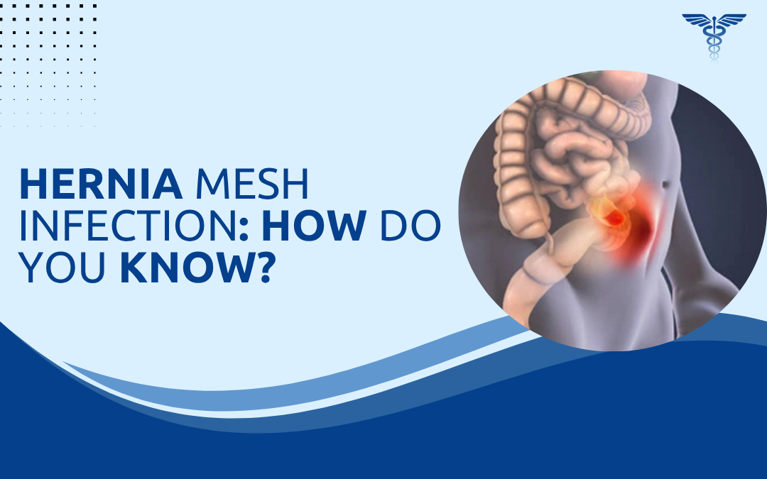 Hernia Mesh Infection How Do You Know