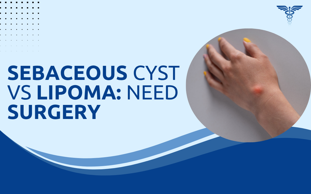 Sebaceous Cyst vs Lipoma Need Surgery