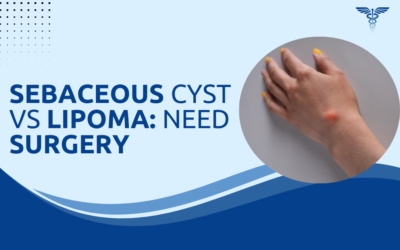 Sebaceous Cyst vs Lipoma: Do You Need Surgery?