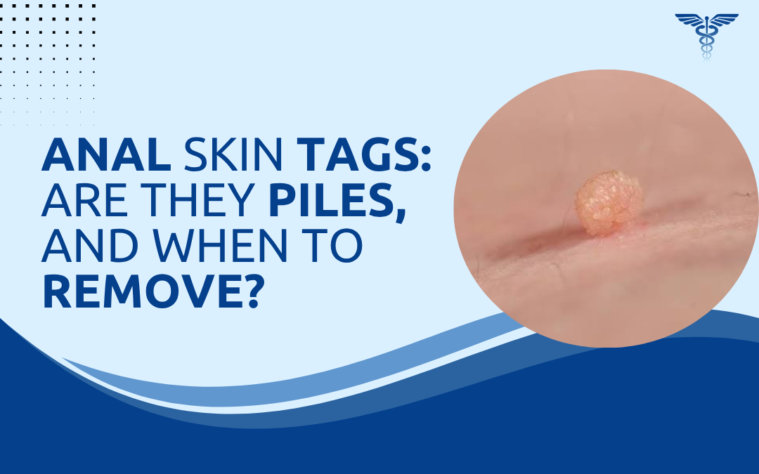 Anal Skin Tags Are They Piles, and When to Remove