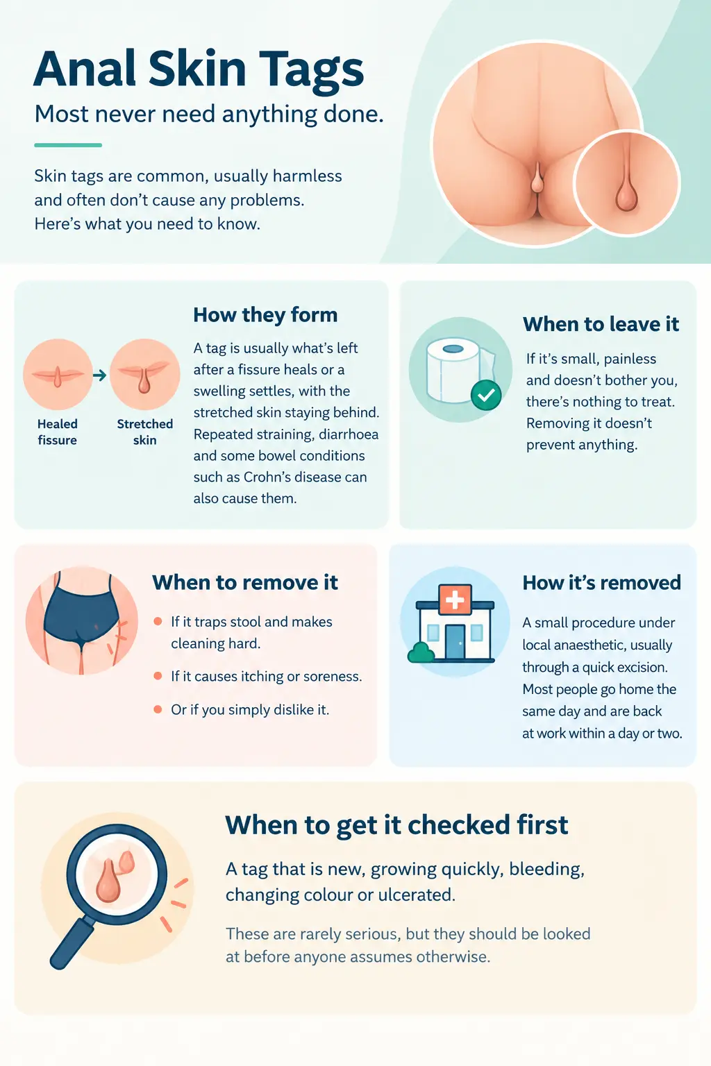 Anal Skin Tags_ A Friendly Guide Anal Skin Tags A Friendly Guide