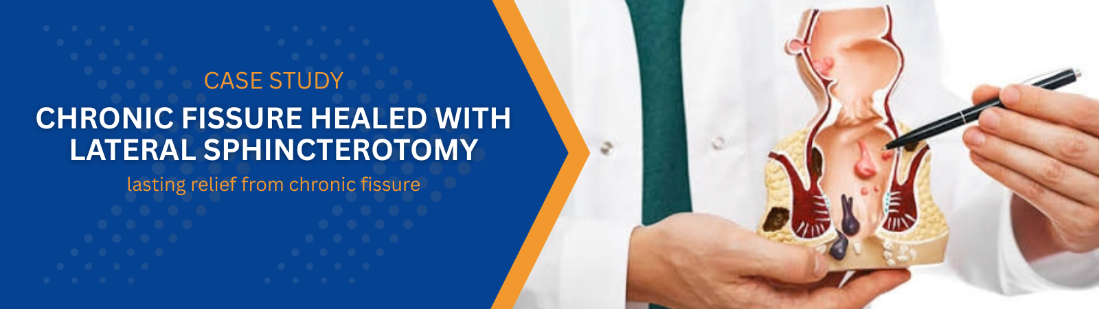 Chronic Fissure Healed with Lateral Sphincterotomy