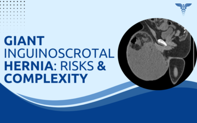 Giant Inguinoscrotal Hernia: Why It Needs Special Planning