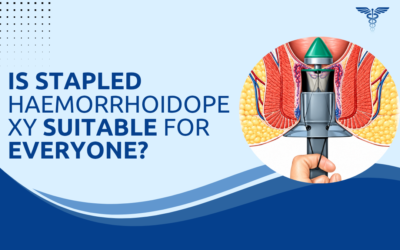 Is Stapled Haemorrhoidopexy Suitable for Everyone?